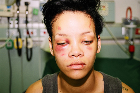 Rihanna Bruised